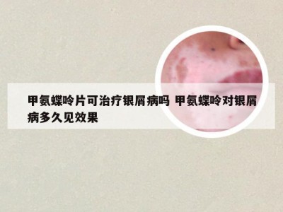 甲氨蝶呤片可治疗银屑病吗 甲氨蝶呤对银屑病多久见效果