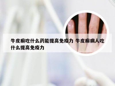 牛皮癣吃什么药能提高免疫力 牛皮癣病人吃什么提高免疫力