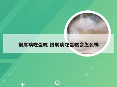 银屑病吃蛋糕 银屑病吃蛋糕会怎么样