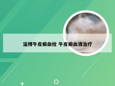 淄博牛皮癣血栓 牛皮癣血液治疗
