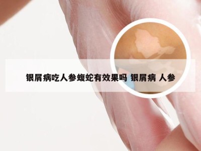 银屑病吃人参蝮蛇有效果吗 银屑病 人参