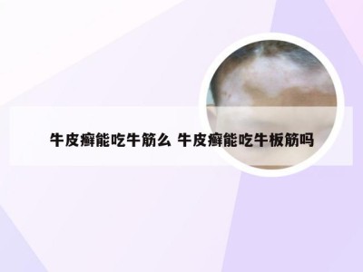 牛皮癣能吃牛筋么 牛皮癣能吃牛板筋吗
