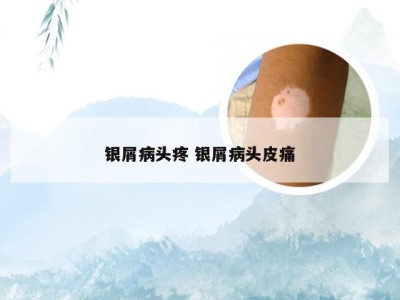 银屑病头疼 银屑病头皮痛