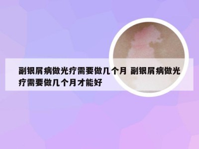 副银屑病做光疗需要做几个月 副银屑病做光疗需要做几个月才能好