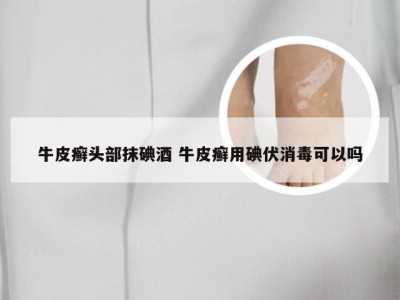 牛皮癣头部抹碘酒 牛皮癣用碘伏消毒可以吗