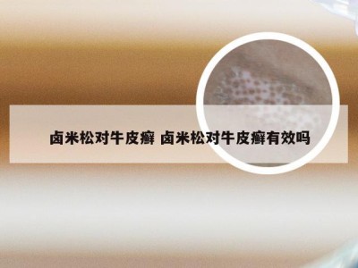 卤米松对牛皮癣 卤米松对牛皮癣有效吗