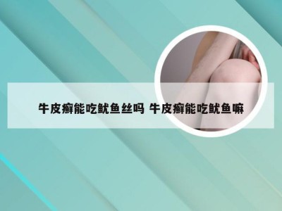 牛皮癣能吃鱿鱼丝吗 牛皮癣能吃鱿鱼嘛