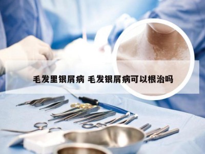 毛发里银屑病 毛发银屑病可以根治吗