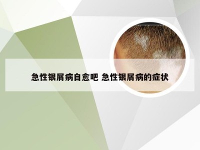 急性银屑病自愈吧 急性银屑病的症状