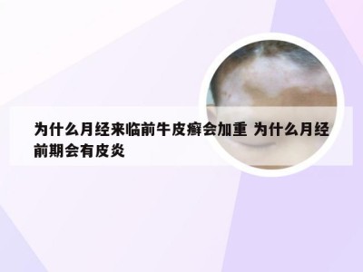为什么月经来临前牛皮癣会加重 为什么月经前期会有皮炎
