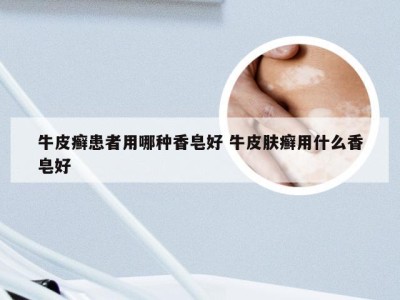牛皮癣患者用哪种香皂好 牛皮肤癣用什么香皂好