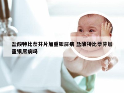 盐酸特比萘芬片加重银屑病 盐酸特比萘芬加重银屑病吗