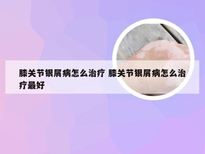 膝关节银屑病怎么治疗 膝关节银屑病怎么治疗最好