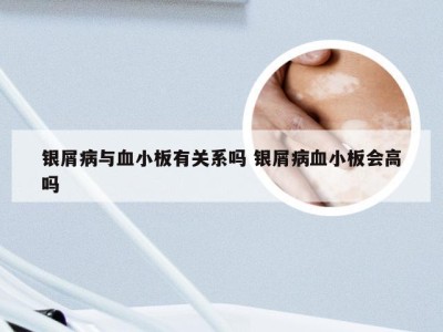 银屑病与血小板有关系吗 银屑病血小板会高吗