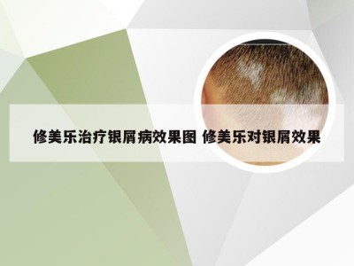 修美乐治疗银屑病效果图 修美乐对银屑效果