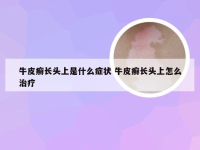 牛皮癣长头上是什么症状 牛皮癣长头上怎么治疗