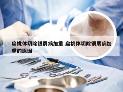 扁桃体切除银屑病加重 扁桃体切除银屑病加重的原因