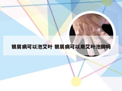 银屑病可以泡艾叶 银屑病可以用艾叶泡脚吗