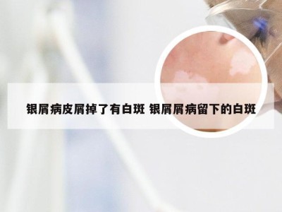 银屑病皮屑掉了有白斑 银屑屑病留下的白斑