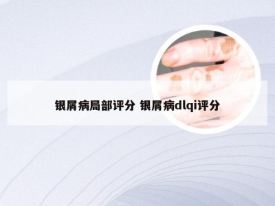 银屑病局部评分 银屑病dlqi评分