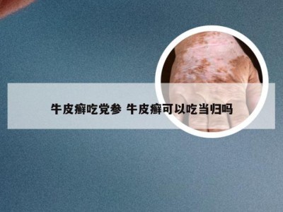牛皮癣吃党参 牛皮癣可以吃当归吗