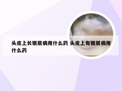 头皮上长银屑病用什么药 头皮上有银屑病用什么药