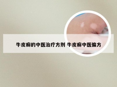 牛皮癣的中医治疗方剂 牛皮癣中医偏方