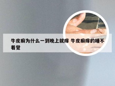 牛皮癣为什么一到晚上就痒 牛皮癣痒的睡不着觉