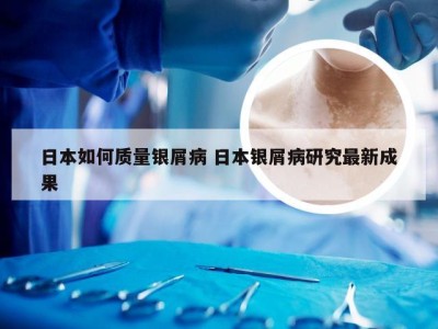 日本如何质量银屑病 日本银屑病研究最新成果