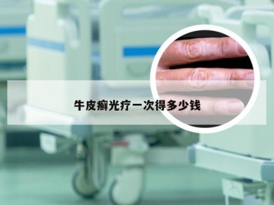 牛皮癣光疗一次得多少钱