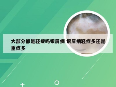 大部分都是轻症吗银屑病 银屑病轻症多还是重症多