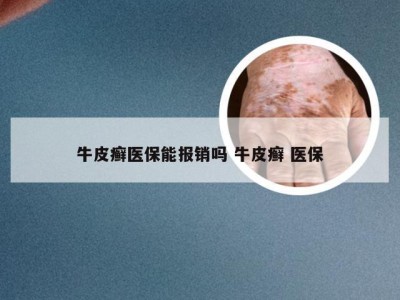 牛皮癣医保能报销吗 牛皮癣 医保