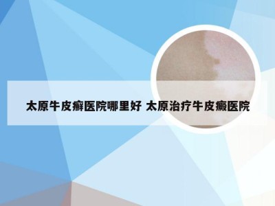 太原牛皮癣医院哪里好 太原治疗牛皮癜医院