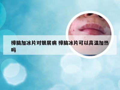 樟脑加冰片对银屑病 樟脑冰片可以高温加热吗