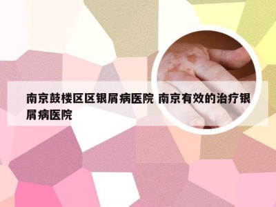 南京鼓楼区区银屑病医院 南京有效的治疗银屑病医院