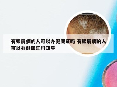 有银屑病的人可以办健康证吗 有银屑病的人可以办健康证吗知乎