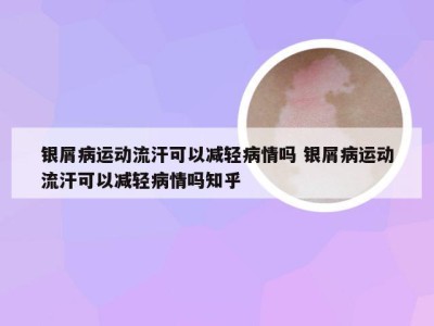 银屑病运动流汗可以减轻病情吗 银屑病运动流汗可以减轻病情吗知乎