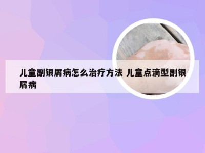 儿童副银屑病怎么治疗方法 儿童点滴型副银屑病