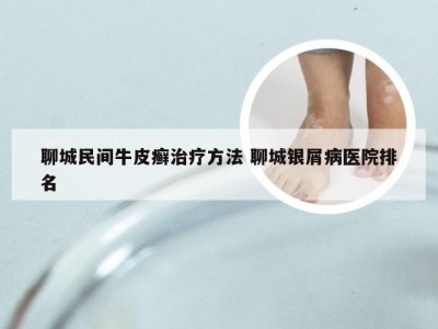 聊城民间牛皮癣治疗方法 聊城银屑病医院排名