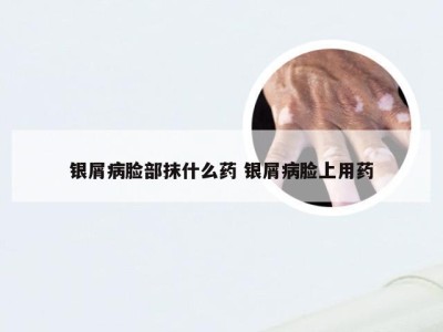 银屑病脸部抹什么药 银屑病脸上用药