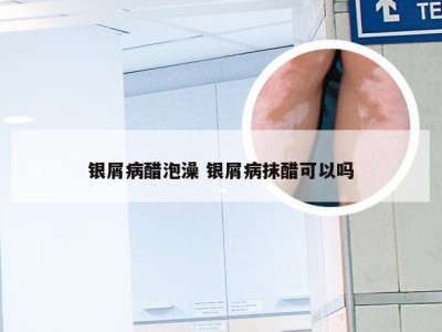银屑病醋泡澡 银屑病抹醋可以吗