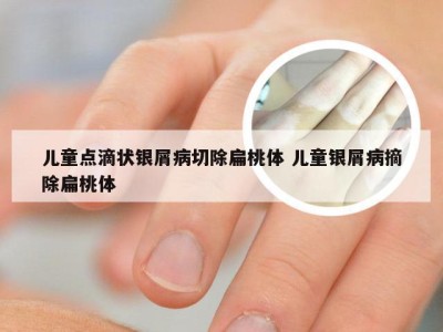 儿童点滴状银屑病切除扁桃体 儿童银屑病摘除扁桃体