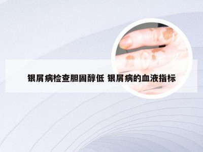银屑病检查胆固醇低 银屑病的血液指标