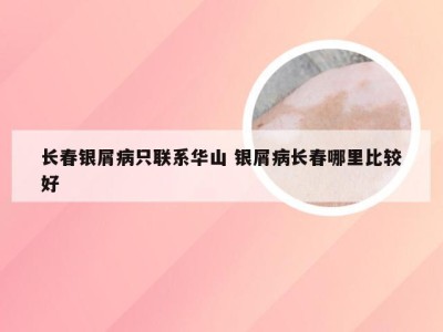 长春银屑病只联系华山 银屑病长春哪里比较好