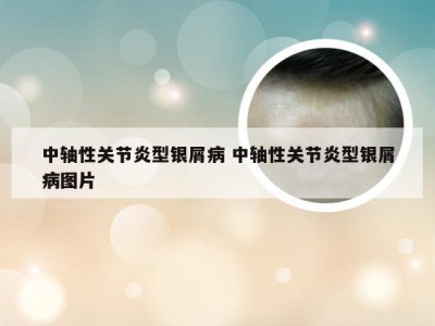 中轴性关节炎型银屑病 中轴性关节炎型银屑病图片