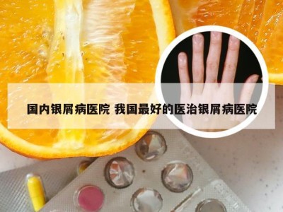国内银屑病医院 我国最好的医治银屑病医院
