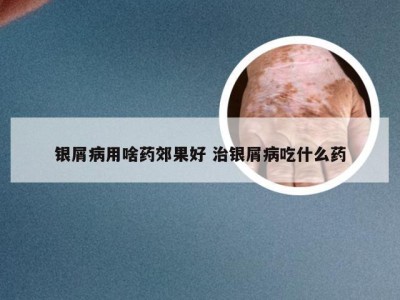 银屑病用啥药郊果好 治银屑病吃什么药