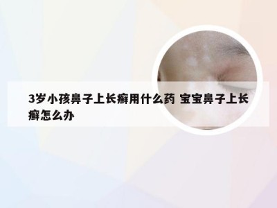 3岁小孩鼻子上长癣用什么药 宝宝鼻子上长癣怎么办