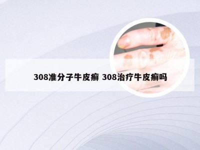 308准分子牛皮癣 308治疗牛皮癣吗