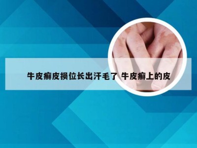 牛皮癣皮损位长出汗毛了 牛皮癣上的皮